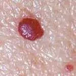 cherry angioma treatment at CNT Clinic chelmsford, essex