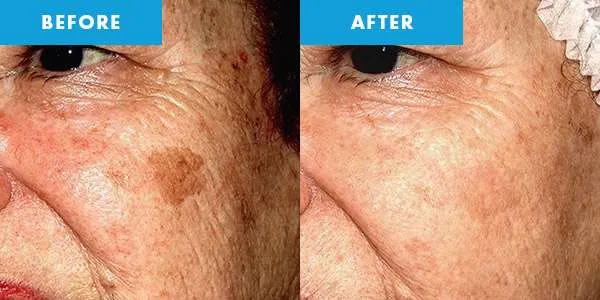 skin pigmentation before and after treatment