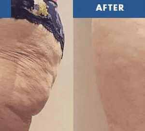 CELLULITE SMOOTHING COURSE