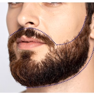 Beard Sculpting - Laser Hair Removal
