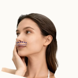 Upper Lip Laser Hair Removal