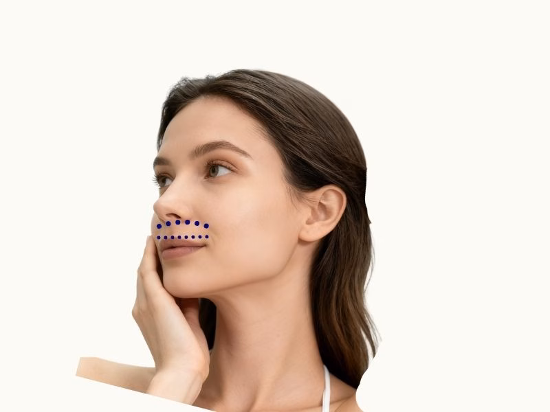 Upper Lip Laser Hair Removal 1 Upper Lip Laser Hair Removal