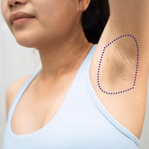 underarm laser hair removal